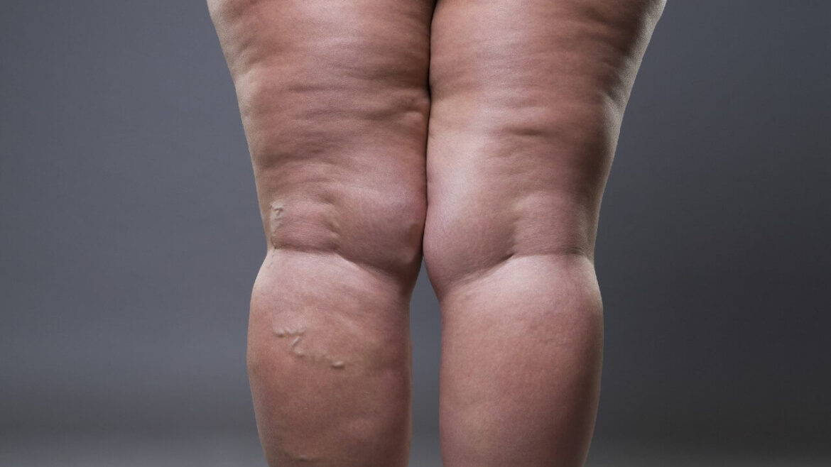 Lipedema